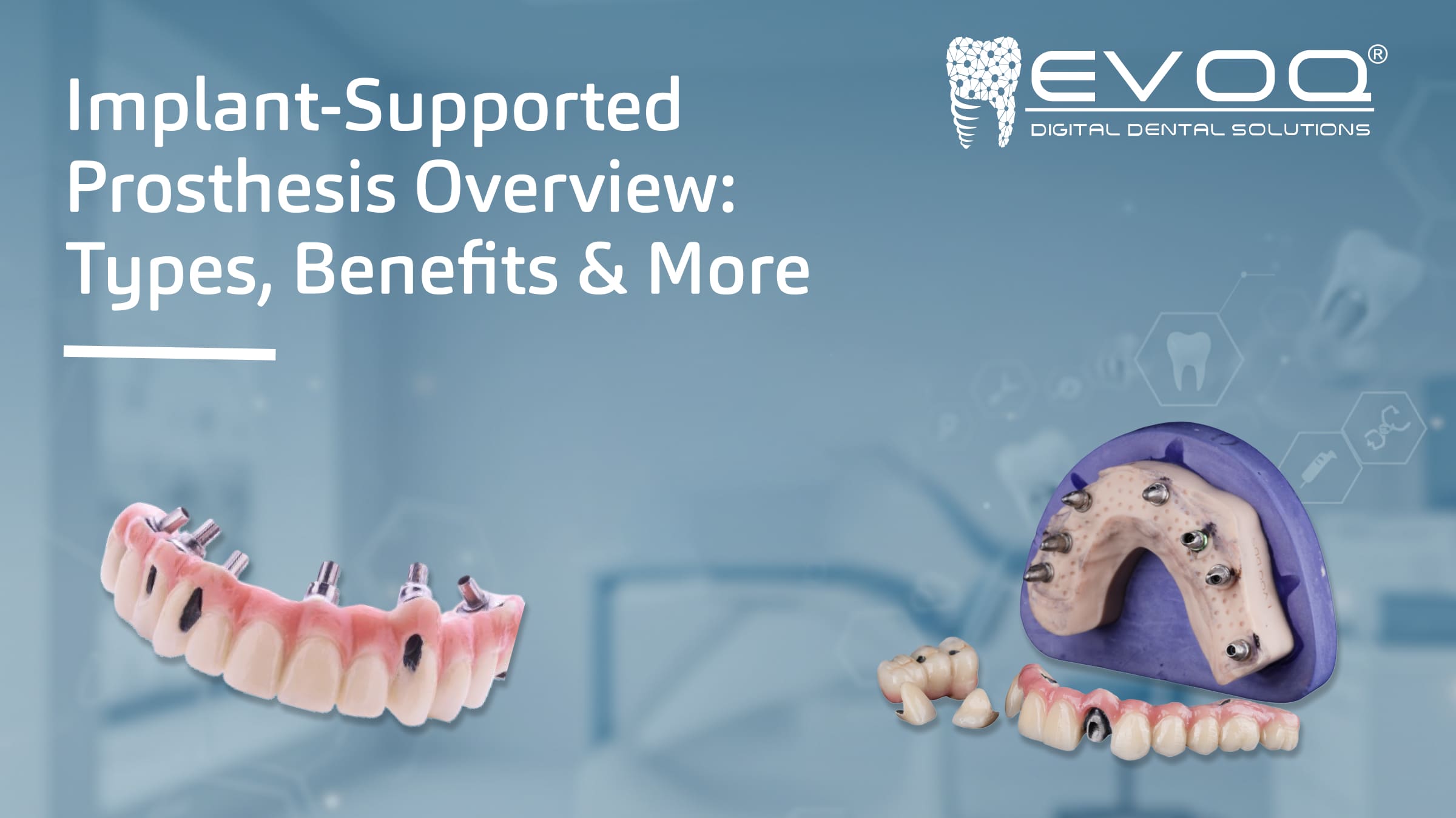 Implant-Supported Prostheses: A Smarter Choice for Tooth Replacement