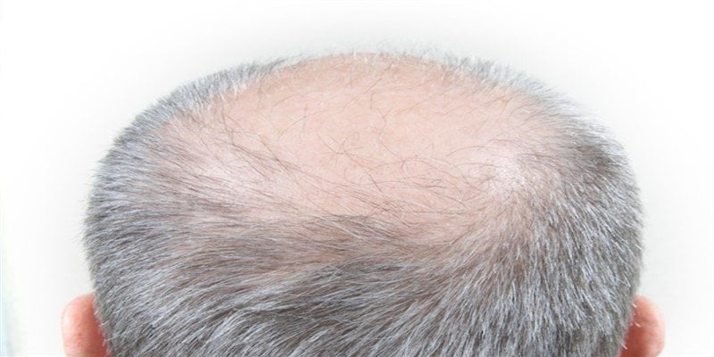 Why Crown Hair Transplant is the Smart Choice