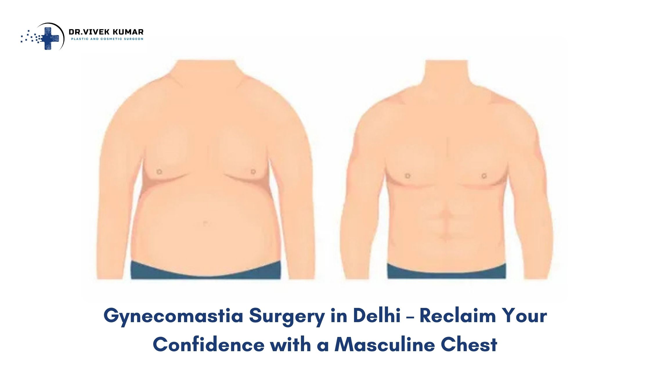 Gynecomastia Surgery in Delhi – Reclaim Your Confidence with a Masculine Chest