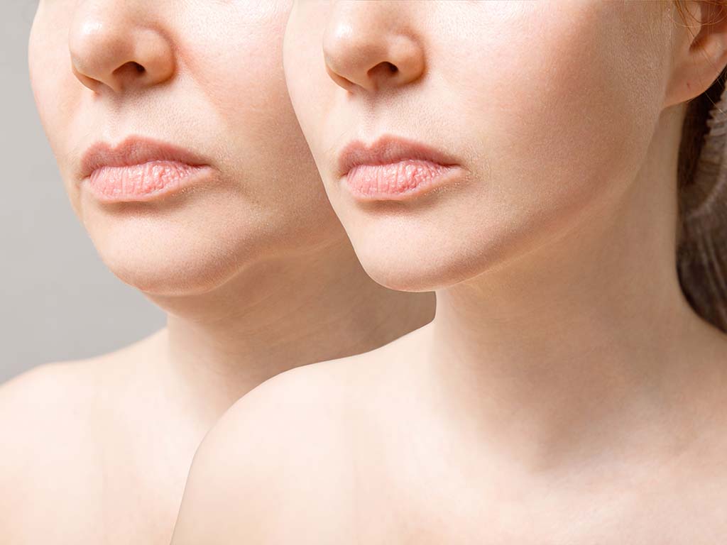 How Does a Facelift Transform Your Appearance?