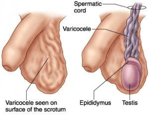 Varicocele Surgery Guide: Recovery Time, Risks, and Results